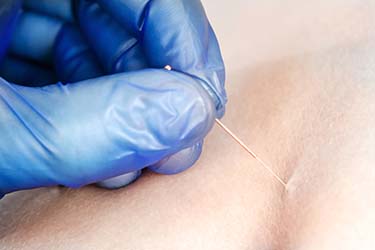 Dry needling therapy